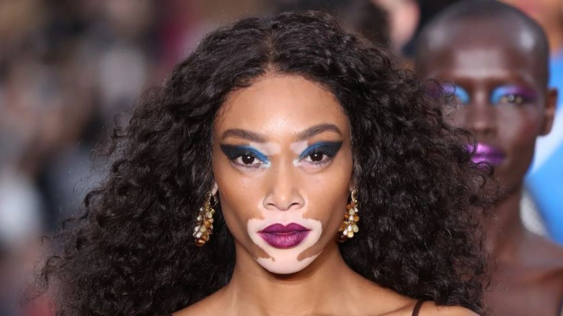 vitiligo-cfare-eshte-simptomat-shkaqet-dhe-trajtimi