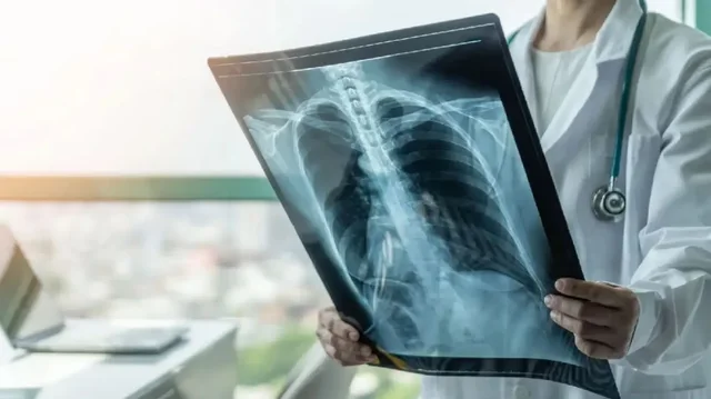 obsh-ngre-alarmin-tuberkulozi-semundja-infektive-me-vdekjeprurese-ne-bote-shkaktoi-1-2-milion-vdekje-ne-2024